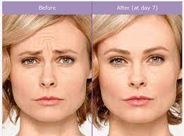 Why could you try to look for blepharoplasty in Santa barbara? post thumbnail image