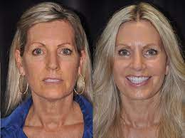 Rediscover Youthful Radiance: Discovering the Best Facelift in Santa Barbara post thumbnail image