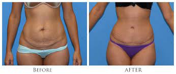 Reclaim Your Contours with a Tummy Tuck in Miami post thumbnail image