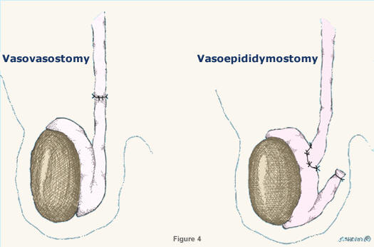 Understanding Vasectomy Reversal: FAQ and Common Concerns post thumbnail image