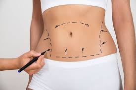 Unlock Your Body’s Potential with Abdominoplasty in Miami post thumbnail image