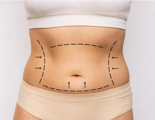 Redefining Confidence: Your Comprehensive Miami Guide to Stunning Abdominoplasty post thumbnail image